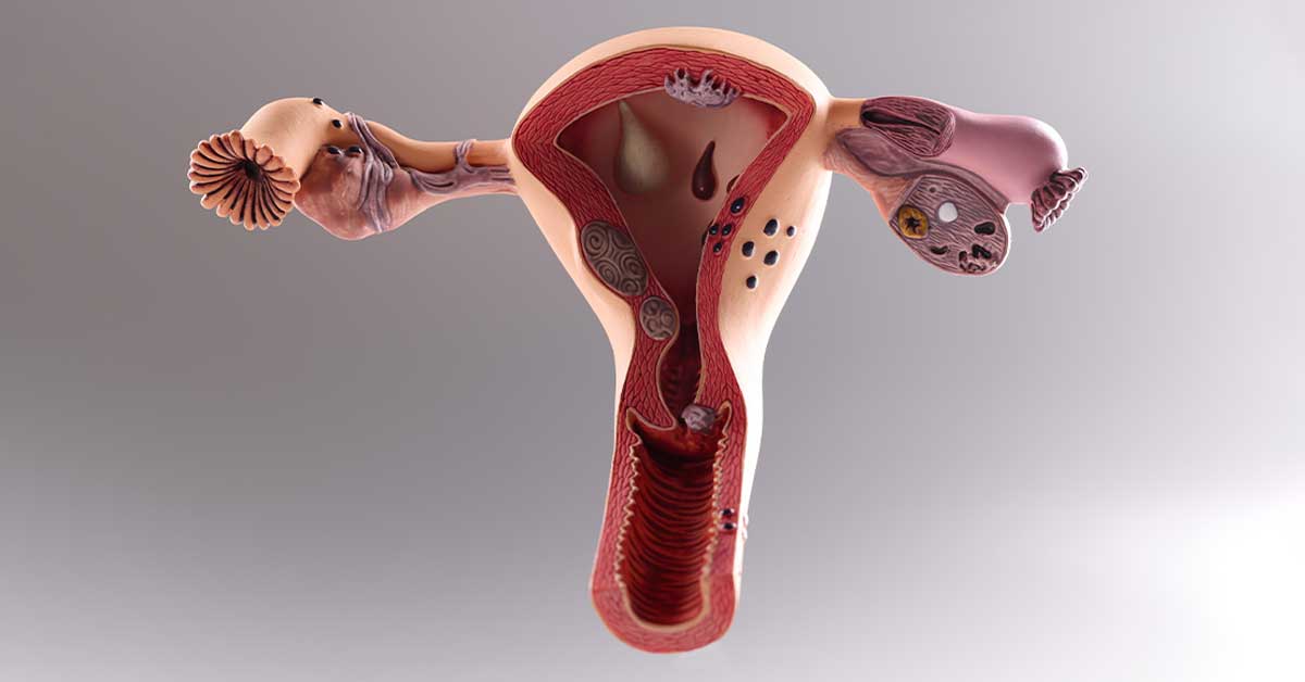 Entendendo a Anovulação e seus efeitos na fertilidade